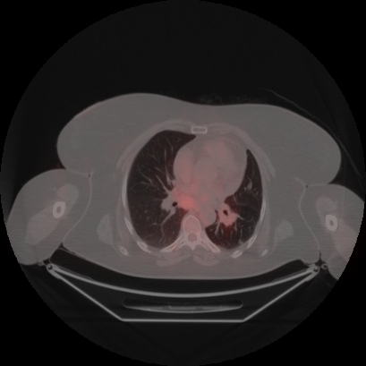 Brain metastasis (Radiopaedia 89847-106962 Axial lung window 31).jpg
