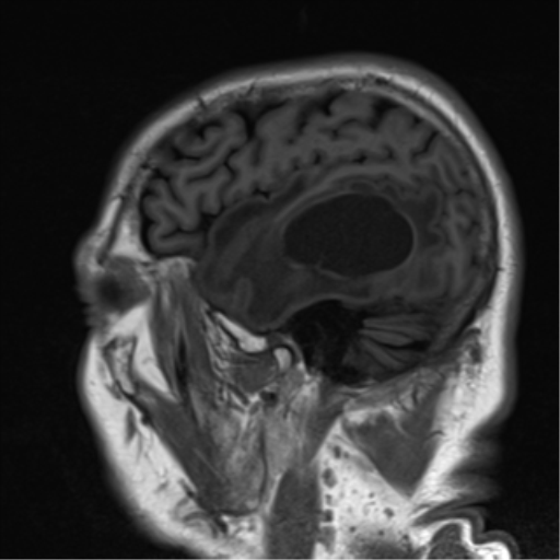 File:Brain metastasis (large cystic mass) (Radiopaedia 47497-52107 Sagittal T1 6).png