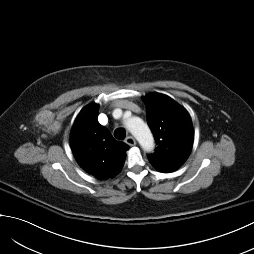 File:Breast carcinoma with pathological hip fracture (Radiopaedia 60314-67974 A 15).jpg