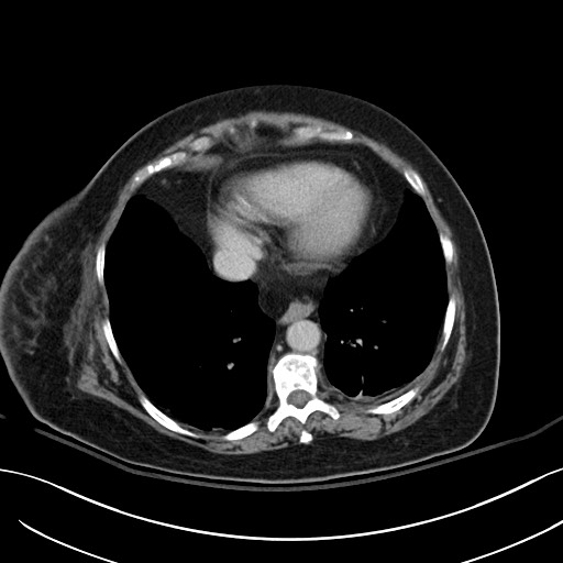 Breast carcinoma with pathological hip fracture (Radiopaedia 60314-67974 B 4).jpg