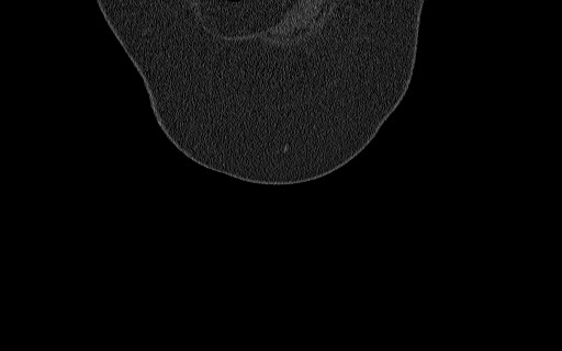 File:Breast carcinoma with pathological hip fracture (Radiopaedia 60314-67993 Coronal bone window 23).jpg