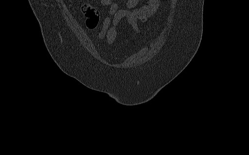 Breast carcinoma with pathological hip fracture (Radiopaedia 60314-67993 Coronal bone window 30).jpg