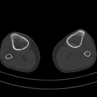Brodie abscess - tibia (Radiopaedia 66028-75204 Axial bone window 13).jpg