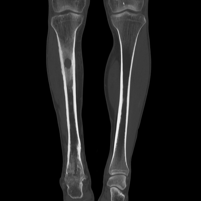 Brodie abscess - tibia (Radiopaedia 66028-75204 Coronal bone window 23).jpg