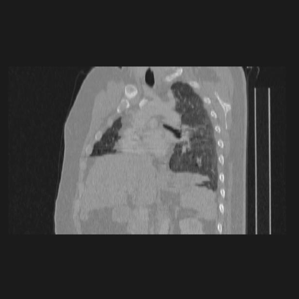 Bronchial atresia (Radiopaedia 60685-68439 Sagittal lung window 49).jpg