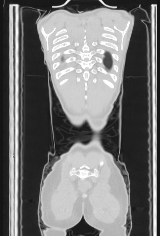 Bronchial carcinoid tumor (Radiopaedia 57187-64090 Coronal lung window 105).jpg
