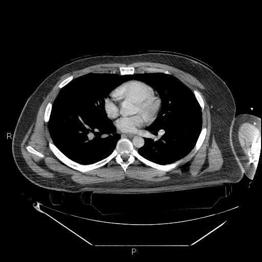 Bronchial carcinoid tumor (Radiopaedia 78272-90870 C 67).jpg
