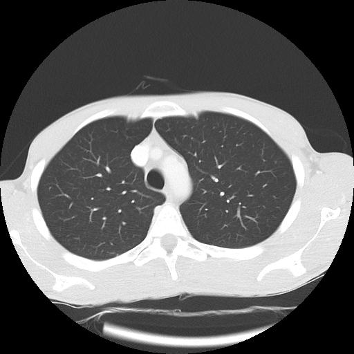 Bronchial carcinoid tumor causing right lower lobe collapse (Radiopaedia 83495-98594 Axial lung window 11).jpg
