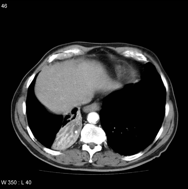 Bronchial carcinoid tumor with right lower lobe collapse (Radiopaedia 29060-29422 A 45).jpg