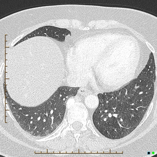 File:Bronchial diverticula (Radiopaedia 79512-92676 Axial lung window 153).jpg