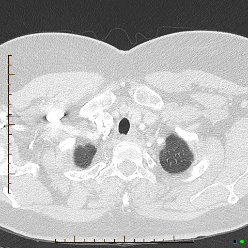 File:Bronchial diverticula (Radiopaedia 79512-92676 Axial lung window 5).jpg
