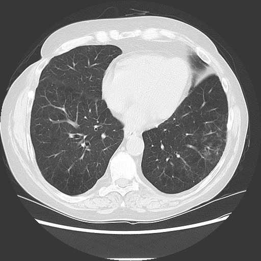 File:Bronchial stenosis - lung transplant (Radiopaedia 73133-83848 Axial lung window 43).jpg