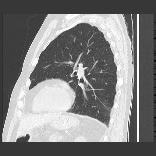 Bronchial stenosis - lung transplant (Radiopaedia 73133-83848 Sagittal lung window 47).jpg