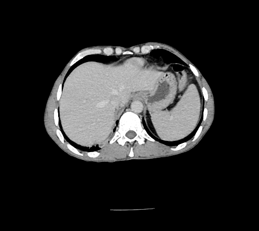 File:Bronchiectasis in Crohn disease (Radiopaedia 60311-67977 B 25).jpg