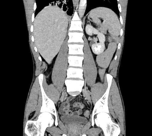 Bronchiectasis in Crohn disease (Radiopaedia 60311-67977 C 51).jpg