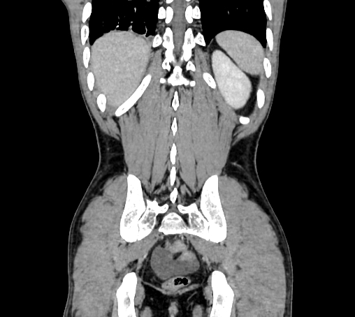 Bronchiectasis in Crohn disease (Radiopaedia 60311-67977 C 71).jpg