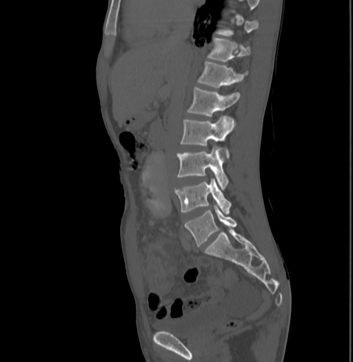 File:Bronchiectasis in Crohn disease (Radiopaedia 60311-67977 Sagittal bone window 105).jpg