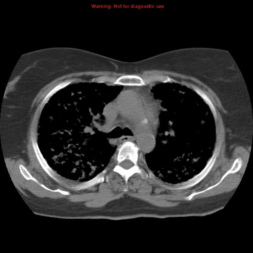 Bronchoalveolar carcinoma (Radiopaedia 13224-13233 Axial non-contrast 17).jpg