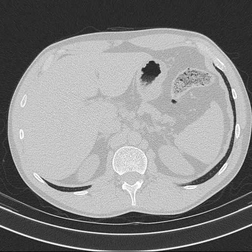 Bronchocele (Radiopaedia 60676-68429 Axial lung window 73).jpg
