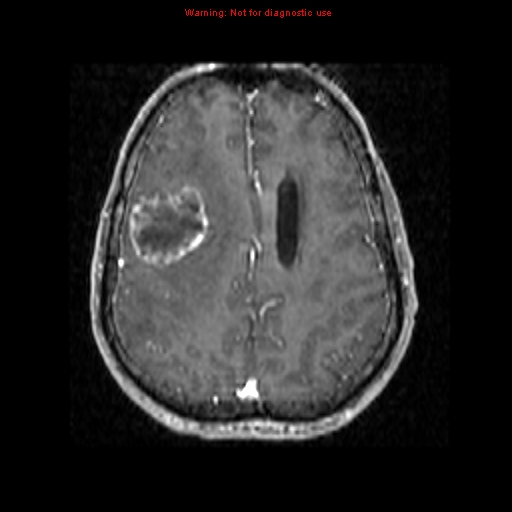 File:Bronchogenic carcinoma brain metastasis (Radiopaedia 9286-9969 Axial T1 C+ 15).jpg