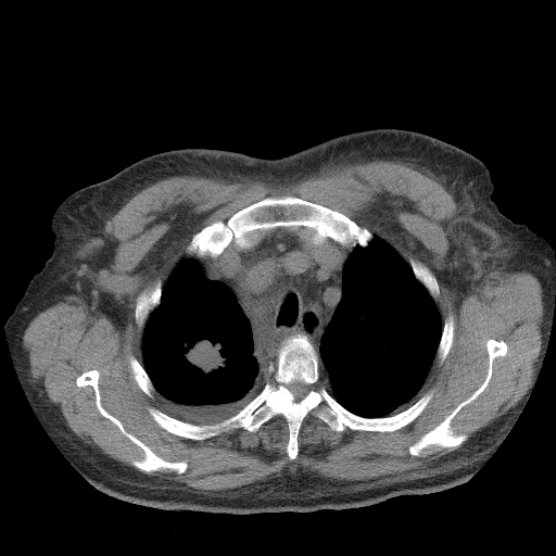 Bronchogenic carcinoma with metastatic lymphadenopathy (Radiopaedia 37671-39569 Axial non-contrast 12).jpg
