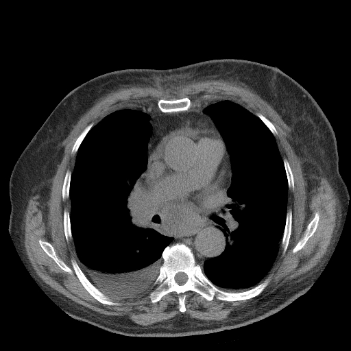 Bronchogenic carcinoma with metastatic lymphadenopathy (Radiopaedia 37671-39569 Axial non-contrast 28).jpg