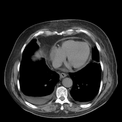 Bronchogenic carcinoma with metastatic lymphadenopathy (Radiopaedia 37671-39569 Axial non-contrast 40).jpg