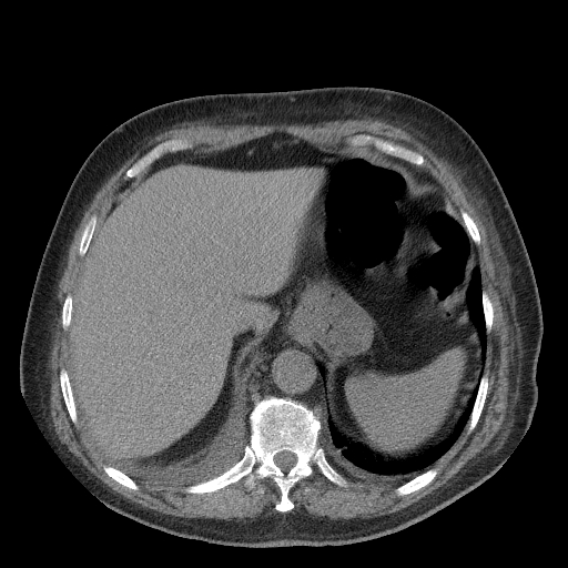 Bronchogenic carcinoma with metastatic lymphadenopathy (Radiopaedia 37671-39569 Axial non-contrast 49).jpg