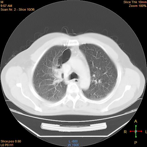 File:Bronchogenic carcinoma with superior vena caval invasion (Radiopaedia 22378-22406 lung window 7).jpg
