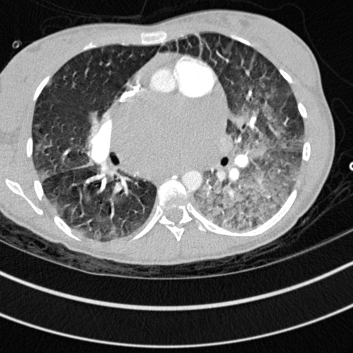 Bronchogenic cyst (Radiopaedia 77801-90071 Axial lung window 35).jpg