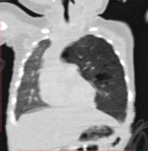 Bronchogenic cyst (Radiopaedia 78599-91409 Coronal lung window 83).jpg