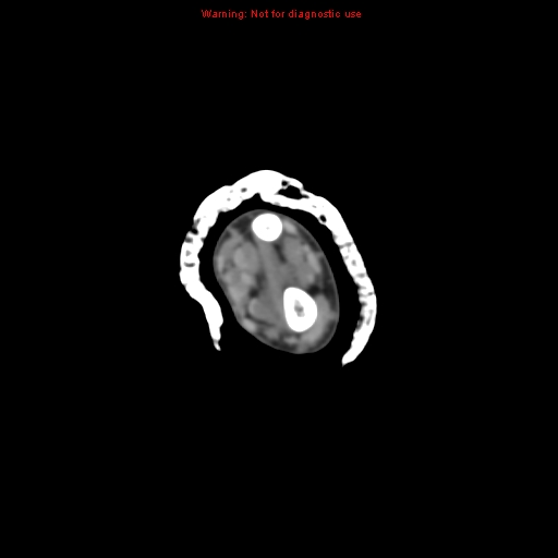 File:Brown tumor (Radiopaedia 12460-12694 Axial non-contrast 35).jpg