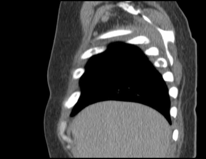 Brown tumors compressing the spinal cord (Radiopaedia 68442-77988 B 13).jpg