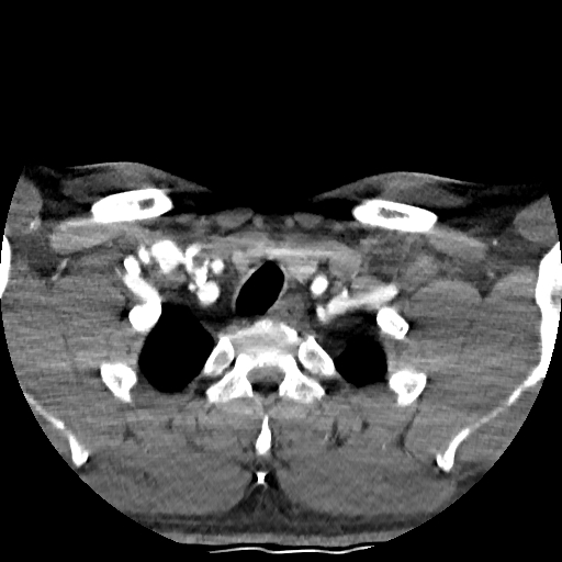 Buccal fat pad arteriovenous malformation (Radiopaedia 70936-81144 D 39).jpg
