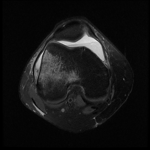 File:Bucket handle meniscus tear (Radiopaedia 56916-63751 Axial PD fat sat 7).jpg