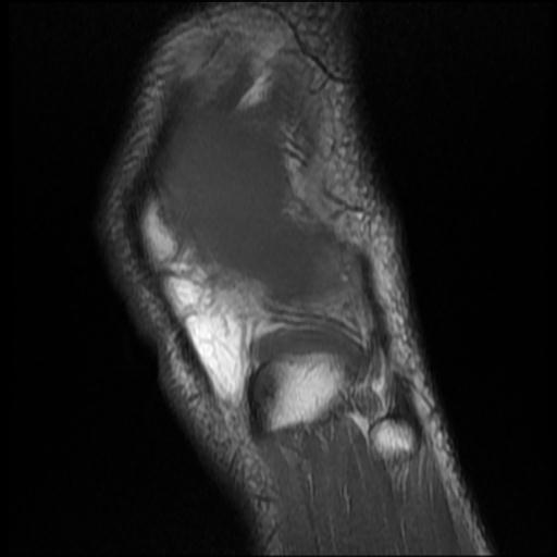 File:Bucket handle tear - medial meniscus (Radiopaedia 69245-79026 Sagittal T1 1).jpg