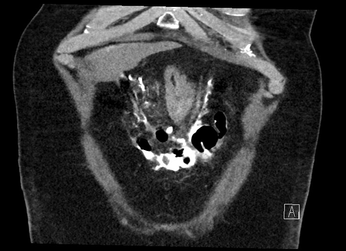 Buried bumper syndrome - gastrostomy tube (Radiopaedia 63843-72577 Coronal Inject 25).jpg