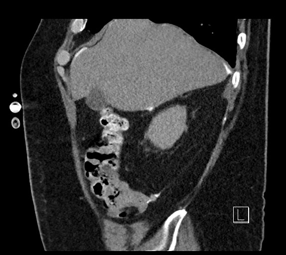 Buried bumper syndrome - gastrostomy tube (Radiopaedia 63843-72577 Sagittal Inject 97).jpg