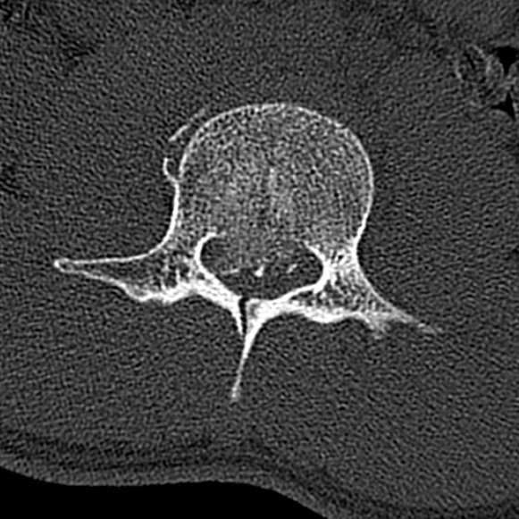 Burst fracture (Radiopaedia 53373-59357 Axial bone window 34).jpg
