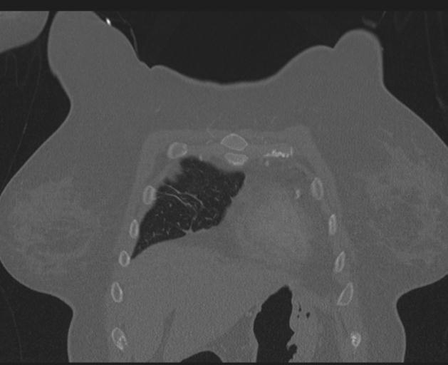 Burst fracture - thoracic spine (Radiopaedia 30238-30865 Coronal bone window 33).jpg