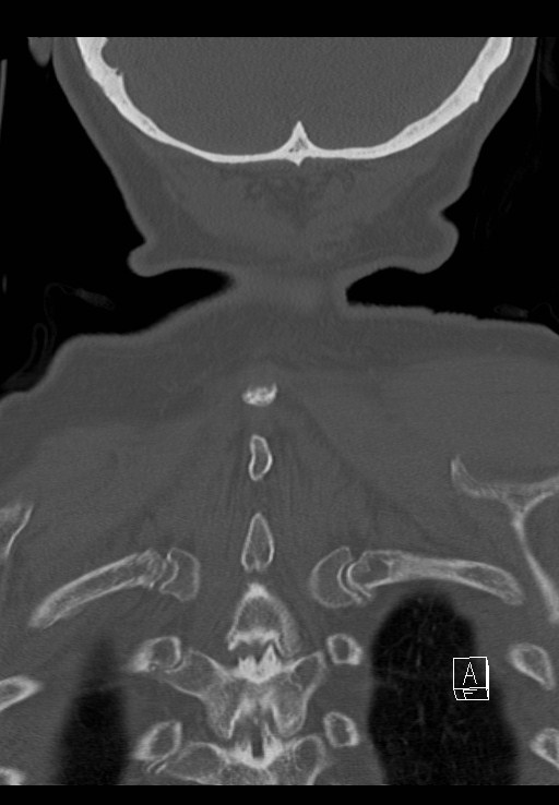 C1 and C2 (peg) fractures (Radiopaedia 36618-38184 Coronal bone window 50).jpg
