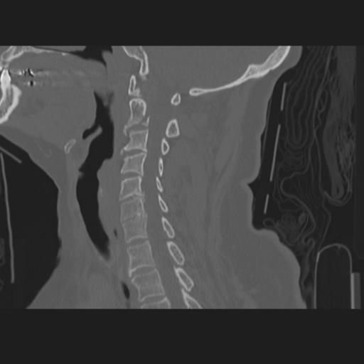 File:C2 fracture (Radiopaedia 34091-35341 Sagittal bone window 33).png