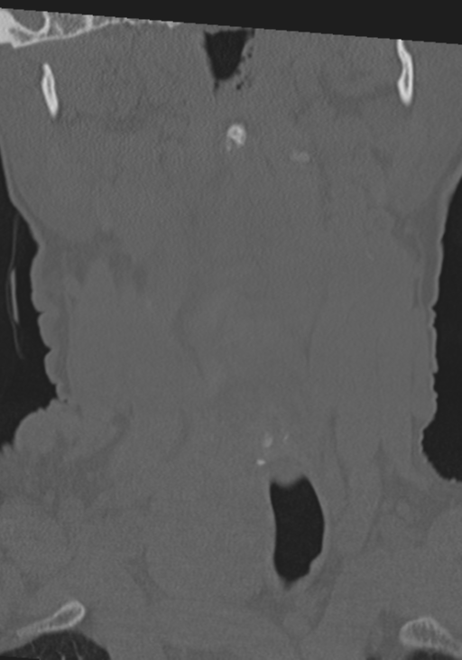 C2 fracture with vertebral artery dissection (Radiopaedia 37378-39199 Coronal bone window 5).png