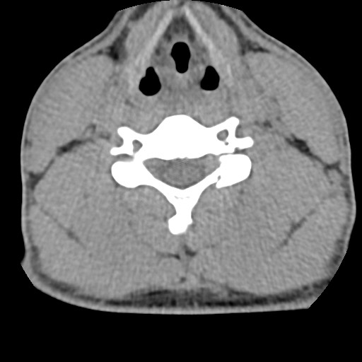 C5 facet fracture (Radiopaedia 58374-65499 Axial non-contrast 54).jpg