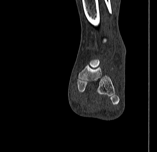 Calcaneal fracture - Sanders type 4 (Radiopaedia 90179-107370 Coronal bone window 53).jpg