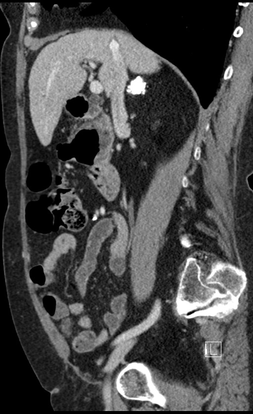 Calcified adrenal glands and Spigelian hernia (Radiopaedia 49741-54988 C 102).jpg