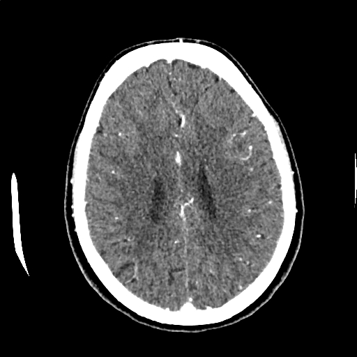 Calcified cerebral hydatid cyst (Radiopaedia 65603-74717 Axial with contrast 52).jpg