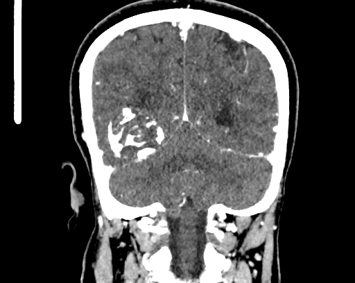 File:Calcified cerebral hydatid cyst (Radiopaedia 65603-74717 C 54).jpg