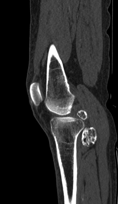 Calcified hematoma - popliteal fossa (Radiopaedia 63938-72763 Sagittal bone window 14).jpg