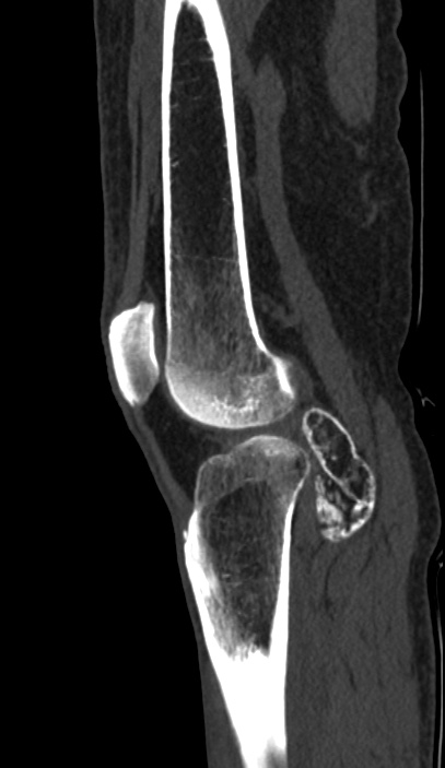 Calcified hematoma - popliteal fossa (Radiopaedia 63938-72763 Sagittal bone window 73).jpg